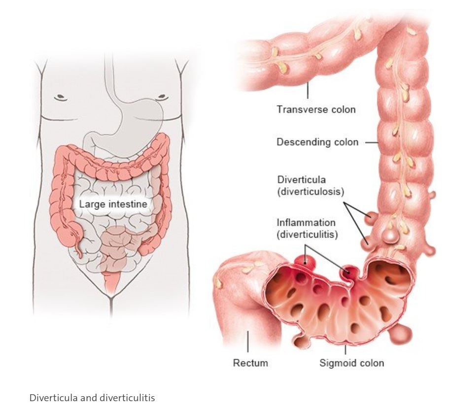 Diverticulosis and Diverticulitis