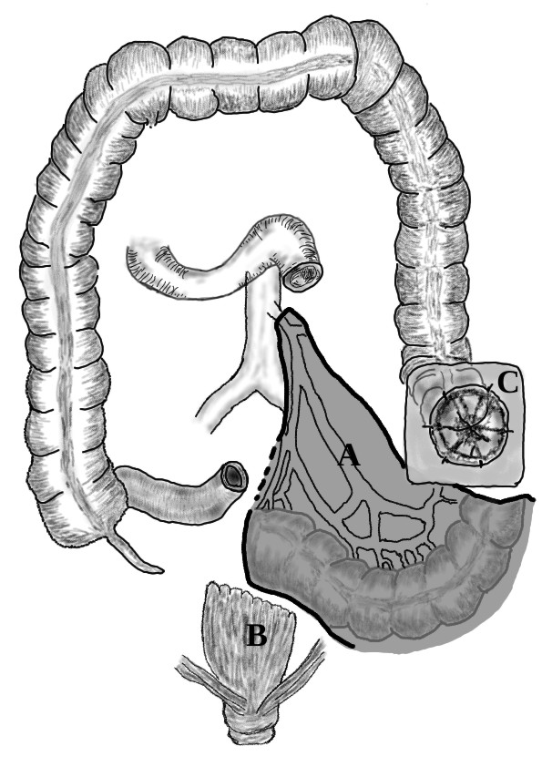 Hartmann's Procedure