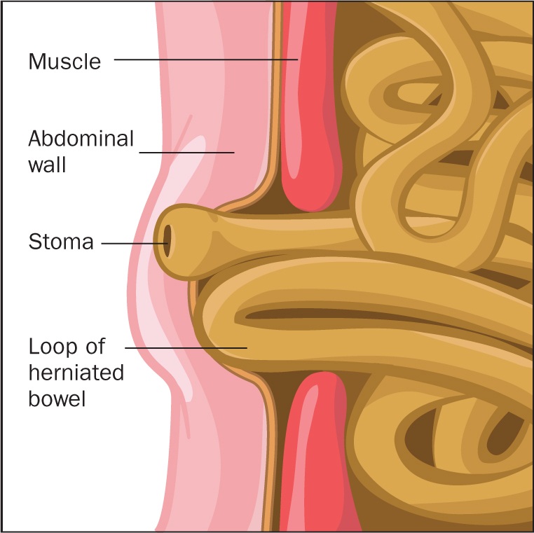 Parastomal Hernia