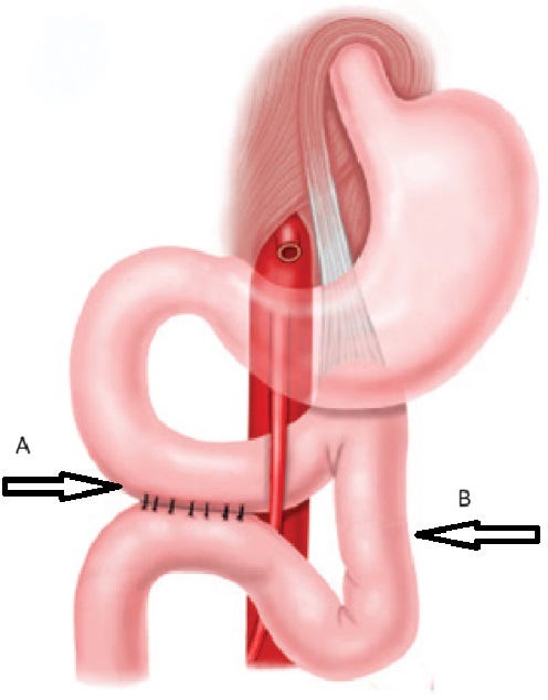 Duodenojejunostomy