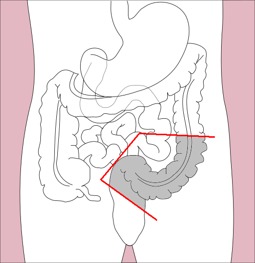 Sigmoidectomy