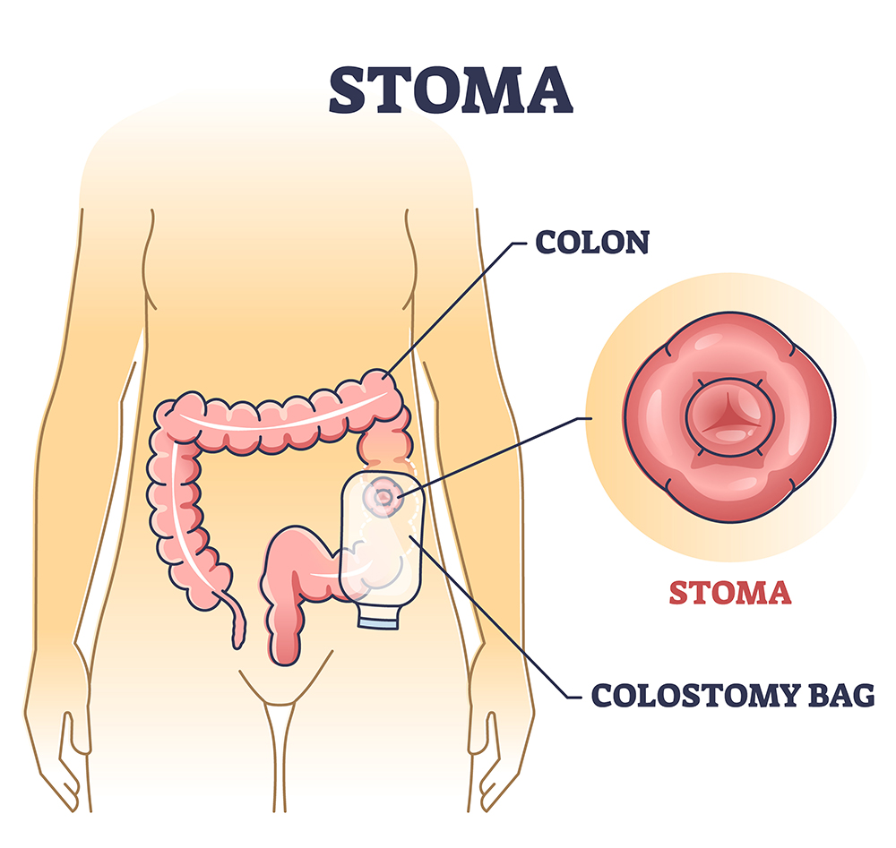 Colostomy